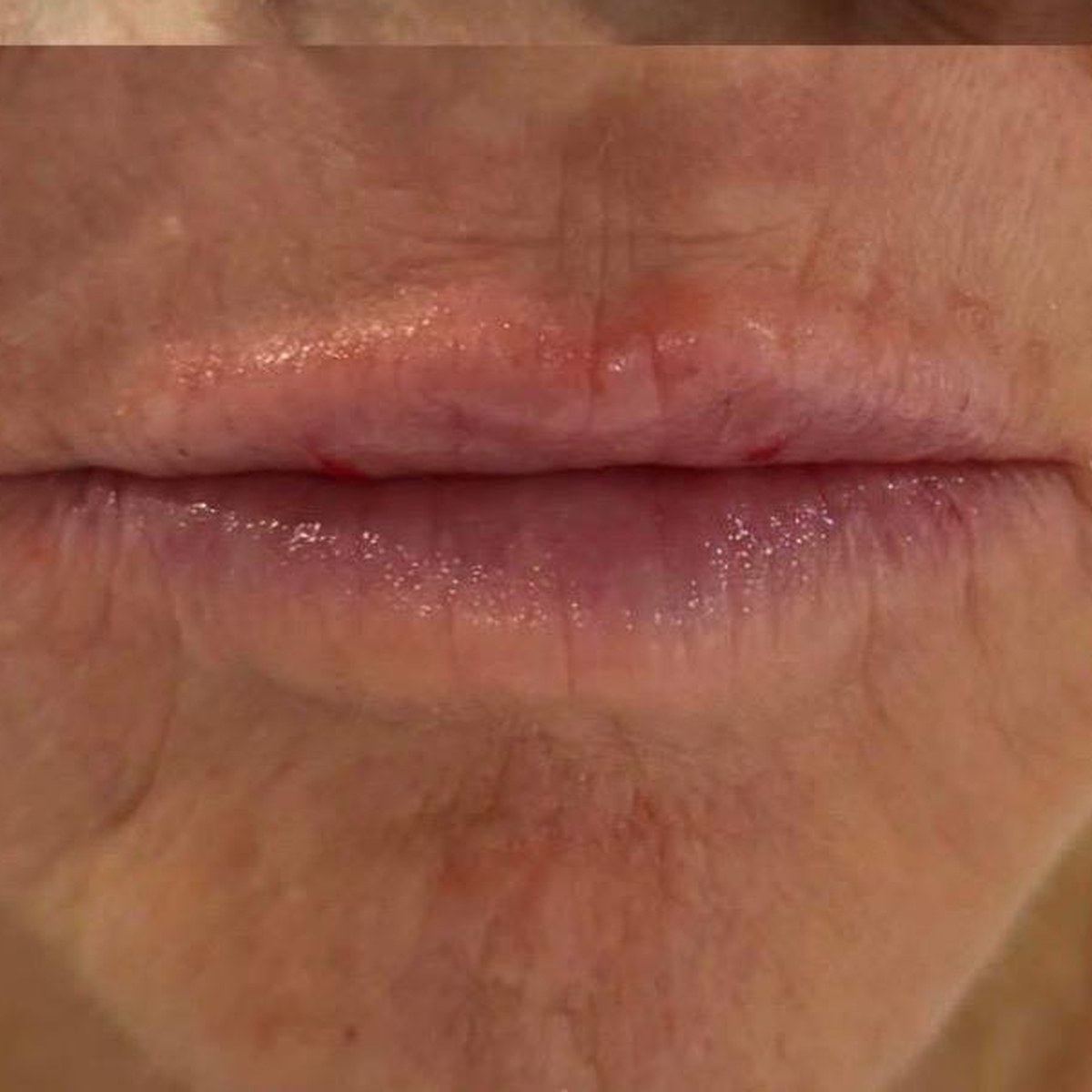 After treatment