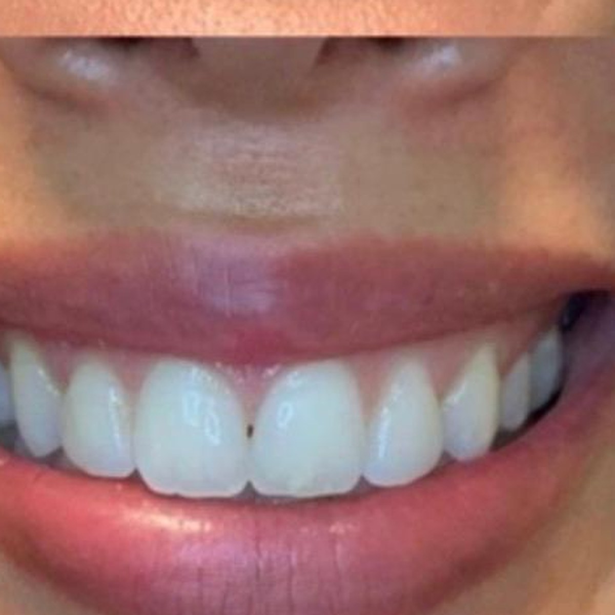 After treatment